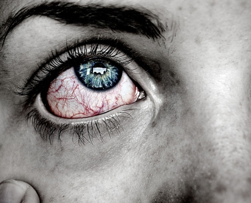 A close-up image of a person's bloodshot eyes signifying an allergic reaction.